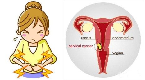 La plupart des femmes négligent ces 2 signes du cancer du col de l’utérus…Important à savoir !
